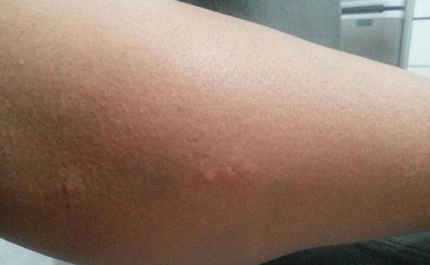 «Me picaron las chinches en la habitación de un hotel de cuatro estrellas en Bilbao»