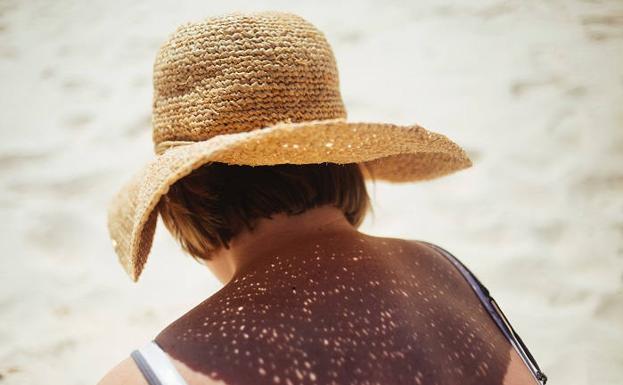 ¿Cómo vivir el verano con una alergia al sol?