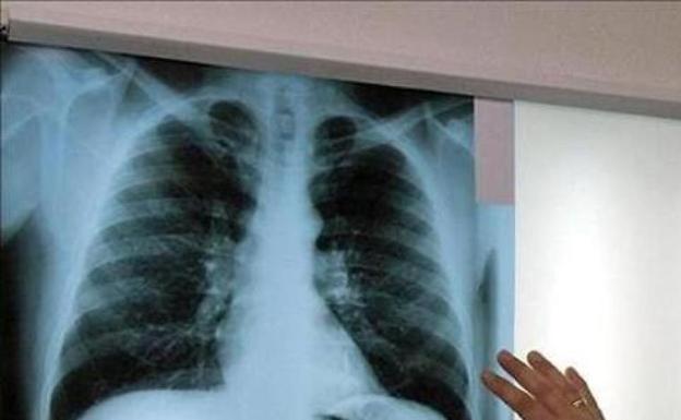 La familia de un fallecido por asbestosis pulmonar tras trabajar con amianto en CAF reclama 148.311 euros