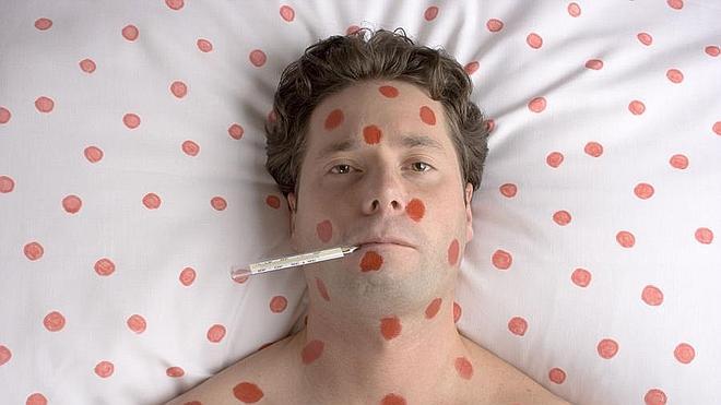 Varicela, la vacuna de la discordia