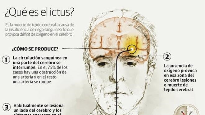 Crecen los ictus entre menores de 65 años en Euskadi por los malos hábitos de vida